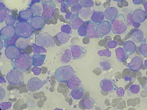 By Paulo Henrique Orlandi MBone marrow aspirate showing acute myeloid leukaemia with Auer rods in several myeloblasts by Paulo Henrique Orlandi Mourao CC BY-SA 3.0, from Wikimedia Commonsourao CC BY-SA 3.0, from Wikimedia Commons