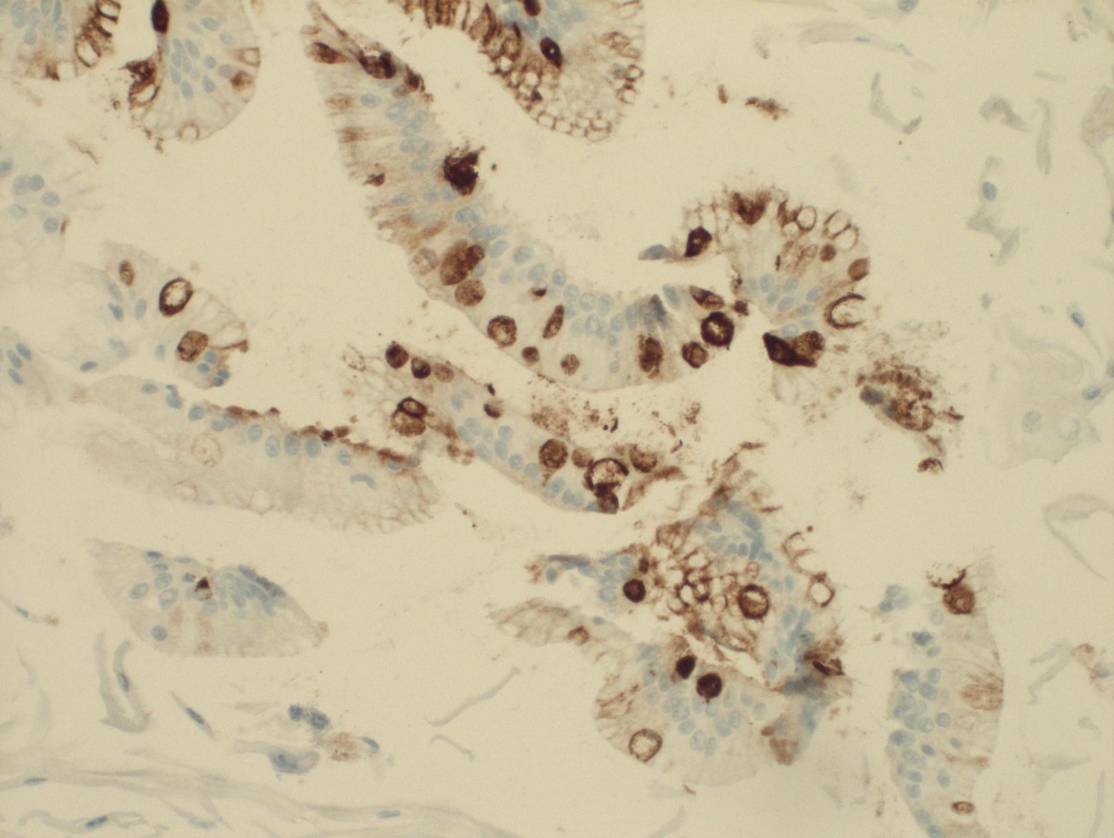 Cells from a Cytosponge sample - the brown areas indicate cells containing the TFF3 marker protein