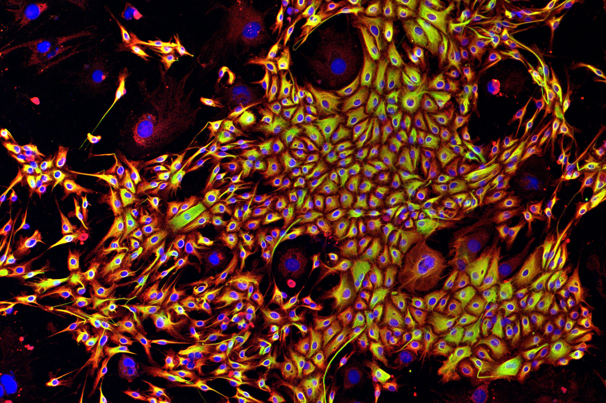 Ovarian cancer cells, CRUK Cambridge Institute