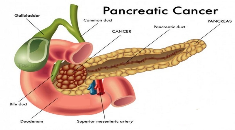 Cancer pancreas | Din ce motive este atat de periculos?