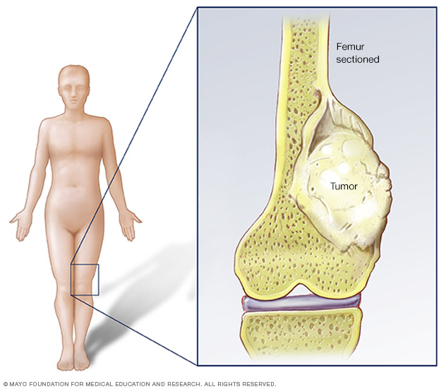 Sarcoma cancer in the bone, Sarcoma cancer information