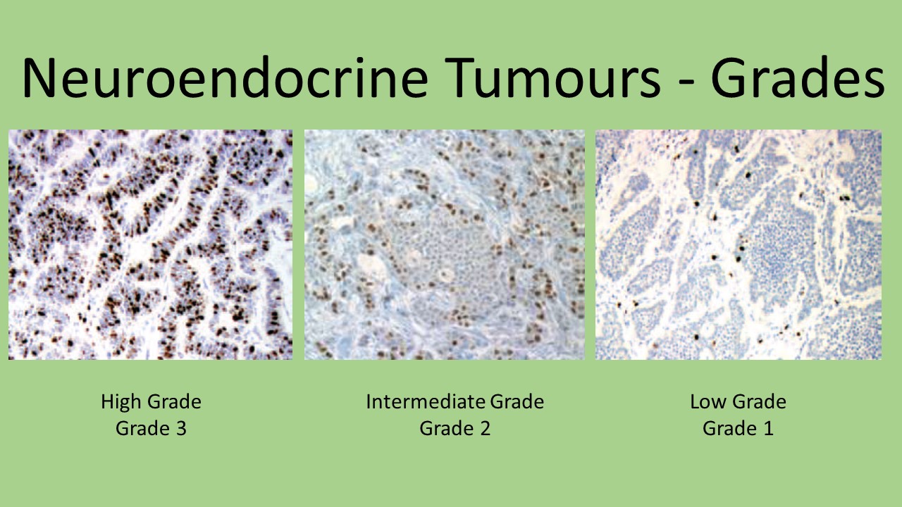 Endocrine cancer uk
