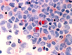 Acute Myeloid Leukaemia AML