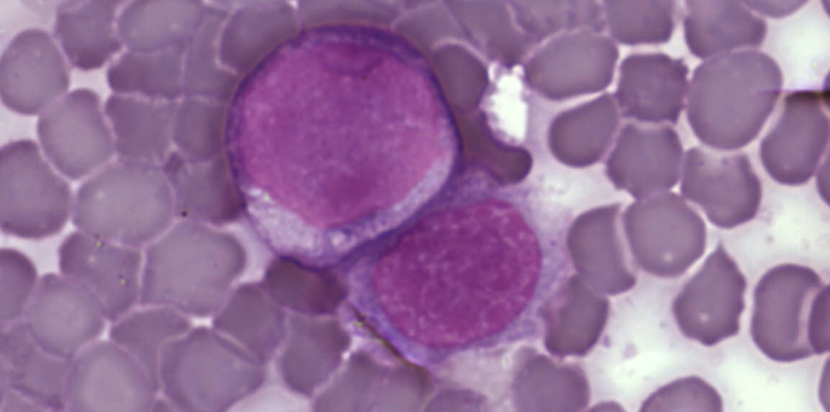 Leukaemia cells (credit: Wikimedia Commons)