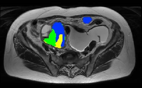 MRI and PET CT scan showing imaging habitats in an ovarian tumour (Credit: Evis Sala, University of Cambridge)