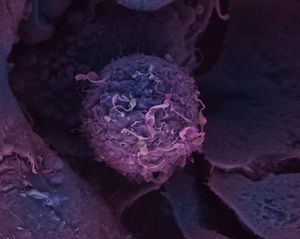 Breast cancer cell (credit: LRI EM Department)