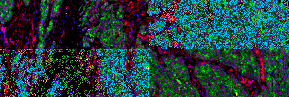 Imaging mass cytometry of a breast tumour revealing tumour cells, stromal cells and blood vessels. Coloured outlines represent areas occupied by single cells; colours correspond to cell classification based on approximately forty proteins.