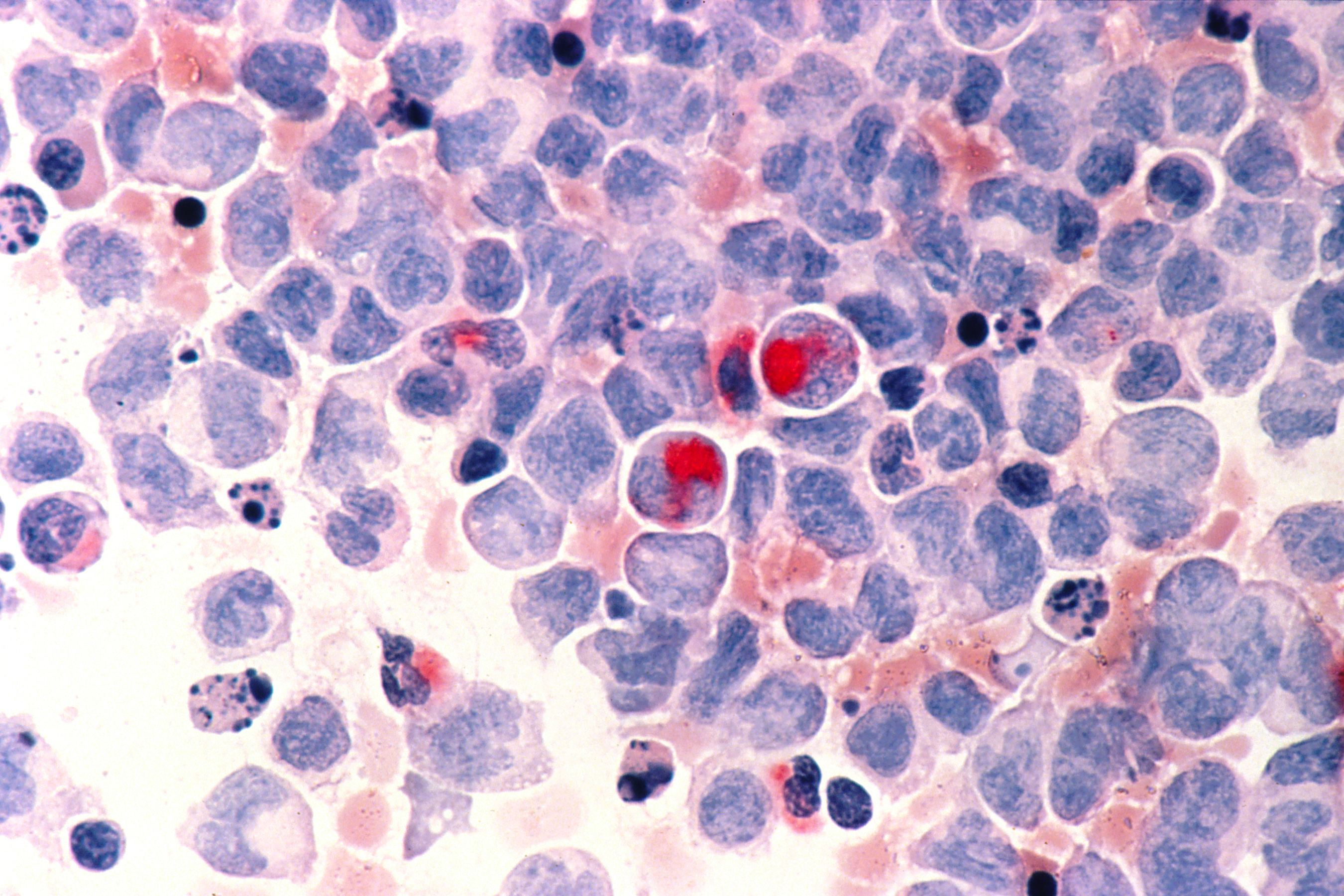Human cells with acute myelocytic leukemia (AML) in the pericardial fluid, shown with an esterase stain at 400x. (credit National Cancer Institute)