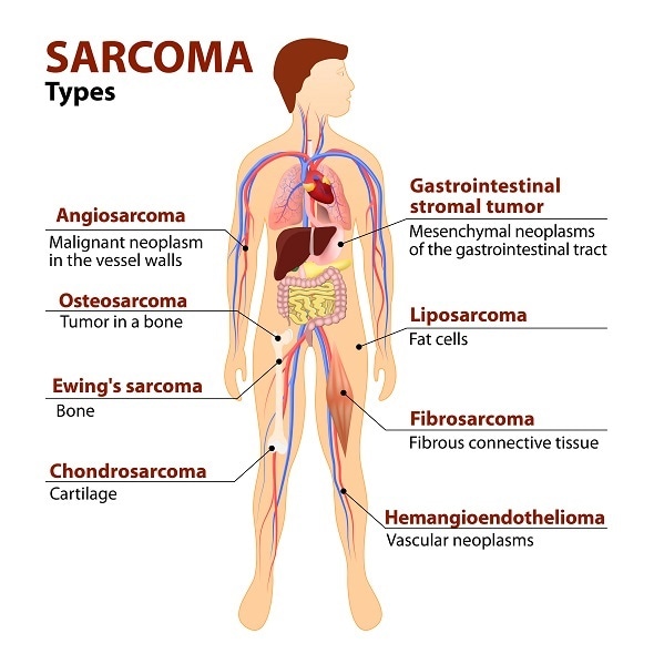 sarcoma cancer medicine