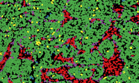 A breast cancer biopsy sample analysed to reveal different types of cells, such as tumour cells in green and connective tissue in red.