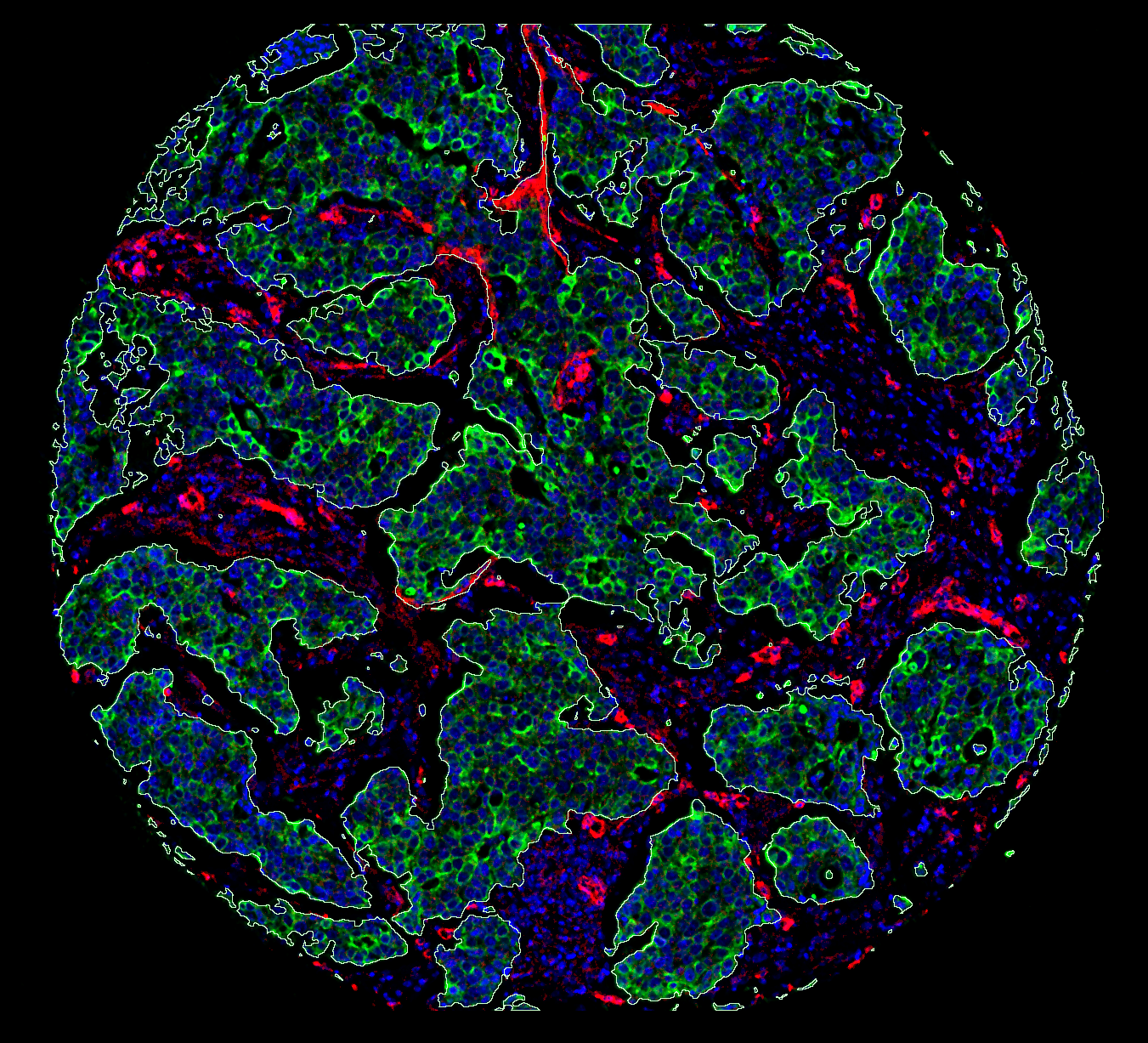 Molecular map of a breast tumour – imaging mass cytometry reveals tumour and stromal areas. Outlines represent the ‘continents’ and ‘islands’ of cancer cells.