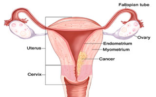 endometrial cancer nhs)